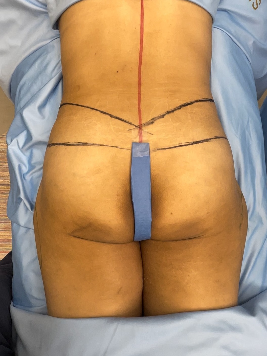Pre-operative marking on patient's lower back.