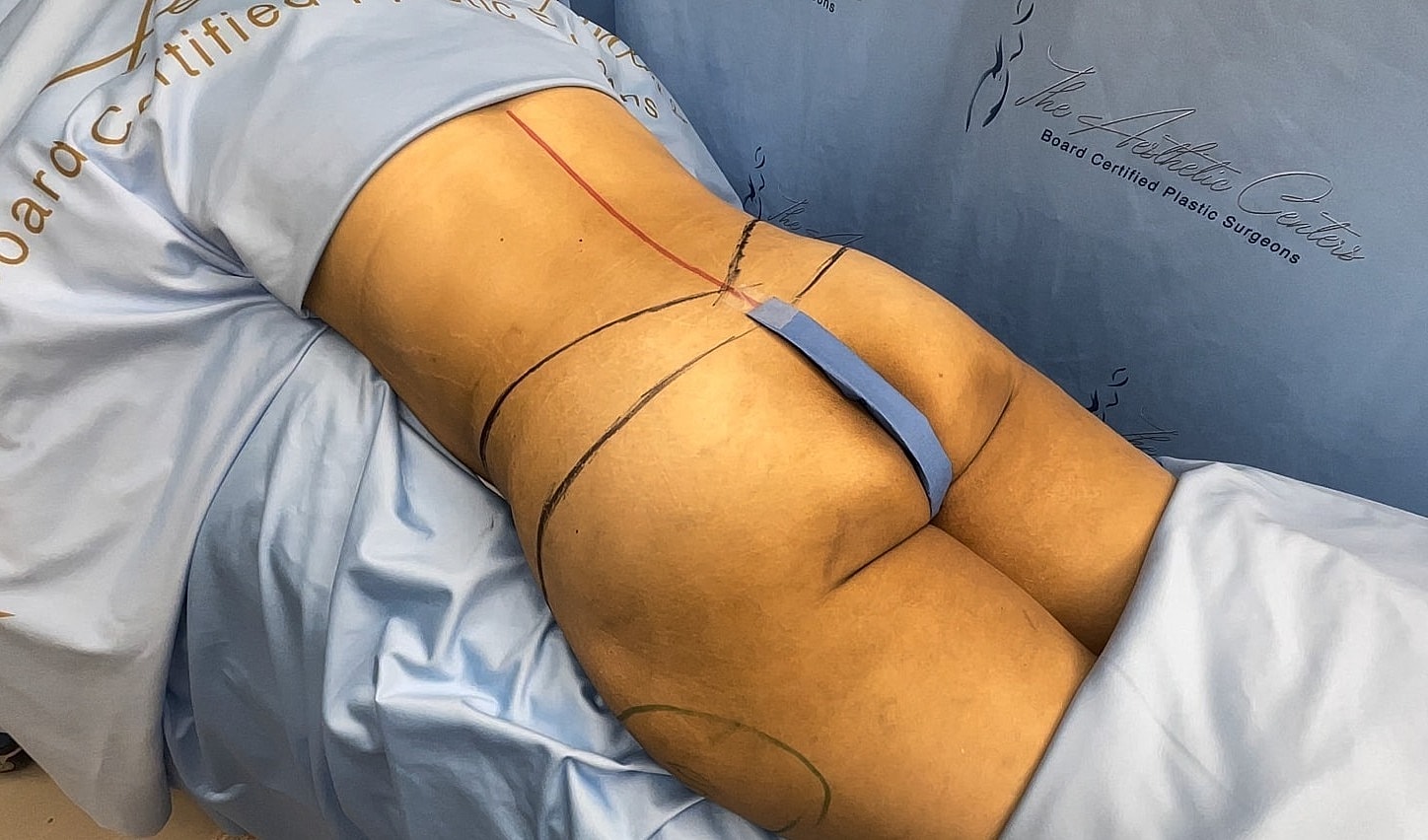 Patient preparing for cosmetic surgery procedure.