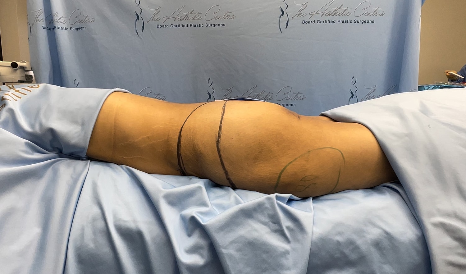 Patient on operating table, marked for surgery.