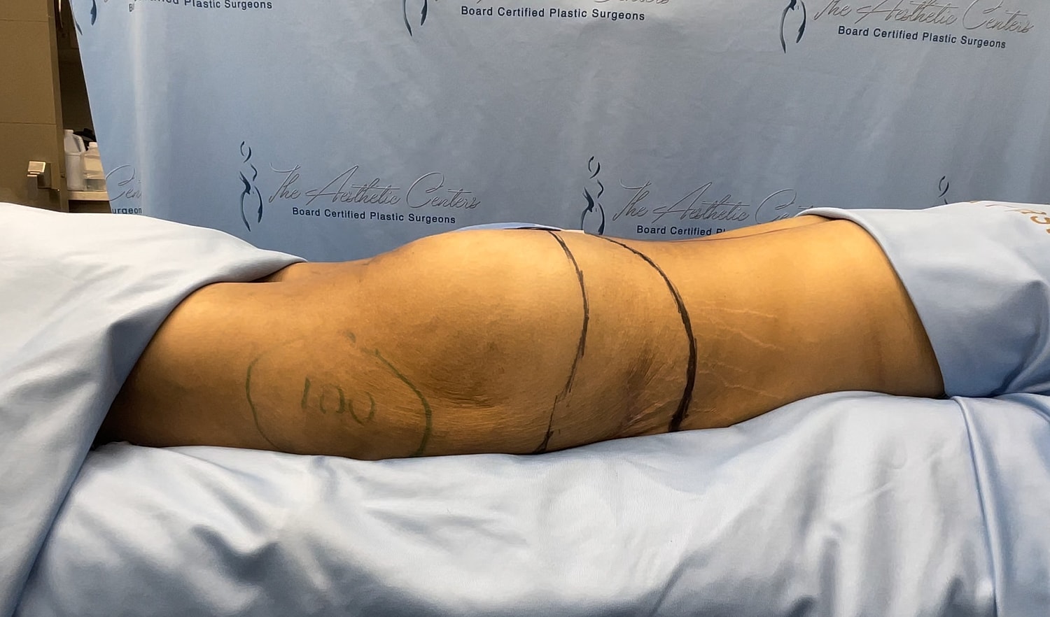 Patient's leg marked for plastic surgery procedure.