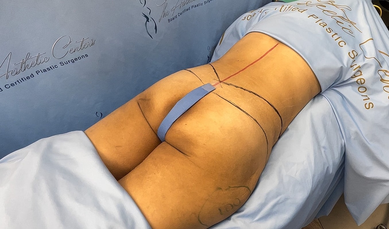 Patient preparing for plastic surgery procedures.