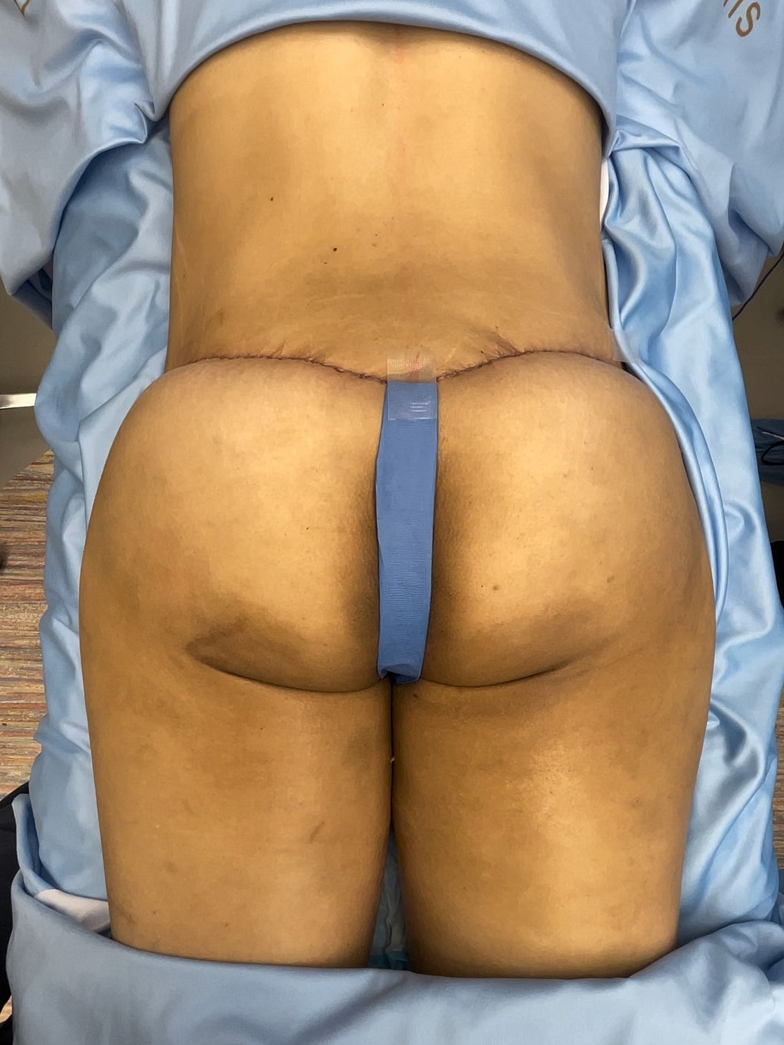 Post-surgery view of lower back and buttocks.