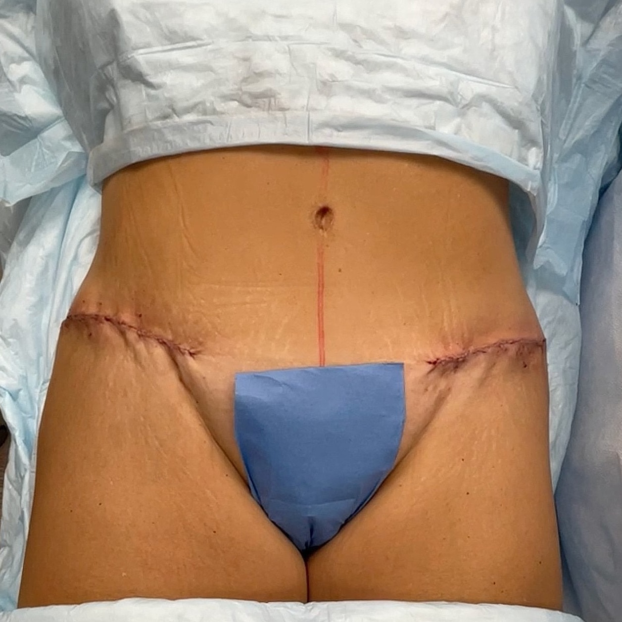 Surgical site with incisions and dressings visible.