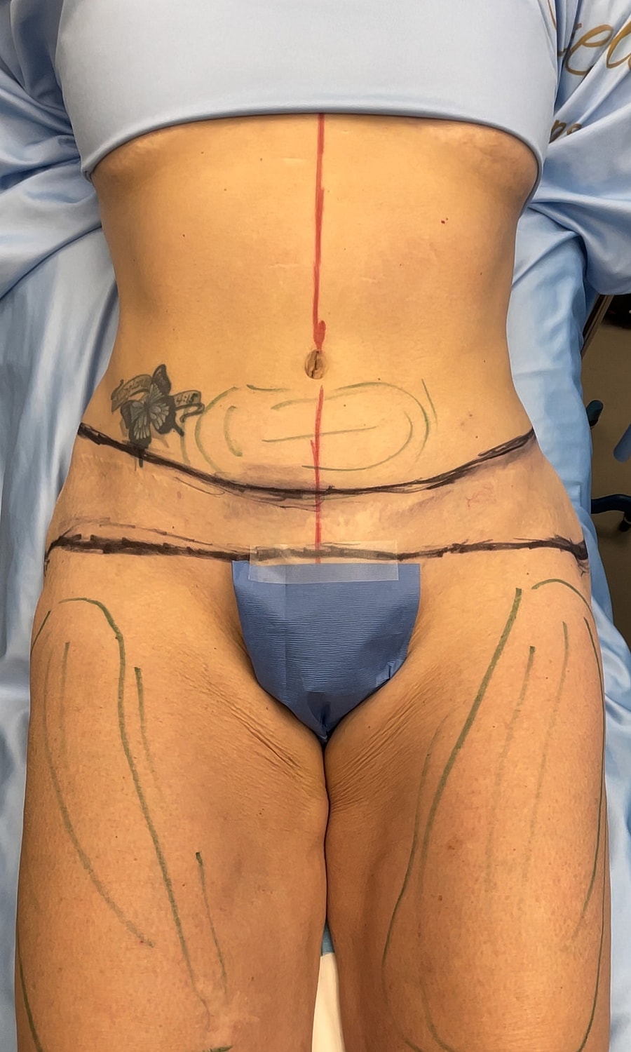 Marked abdomen and thighs for cosmetic procedure.