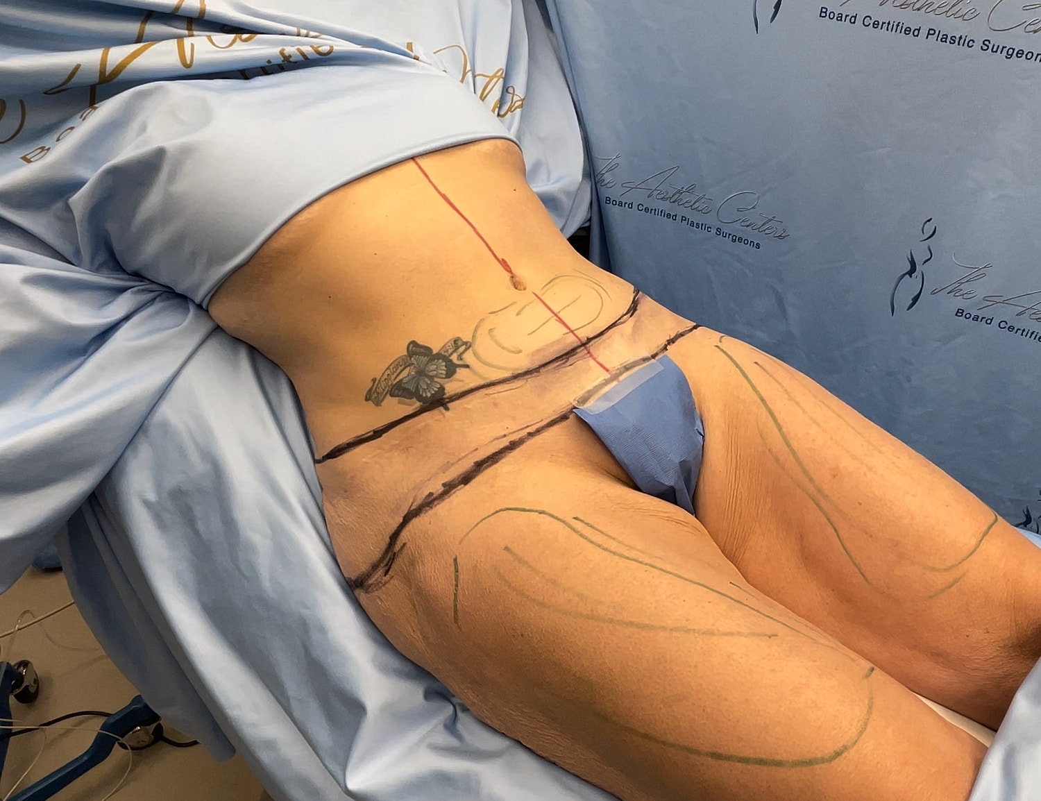 Body contouring markings before plastic surgery procedure.