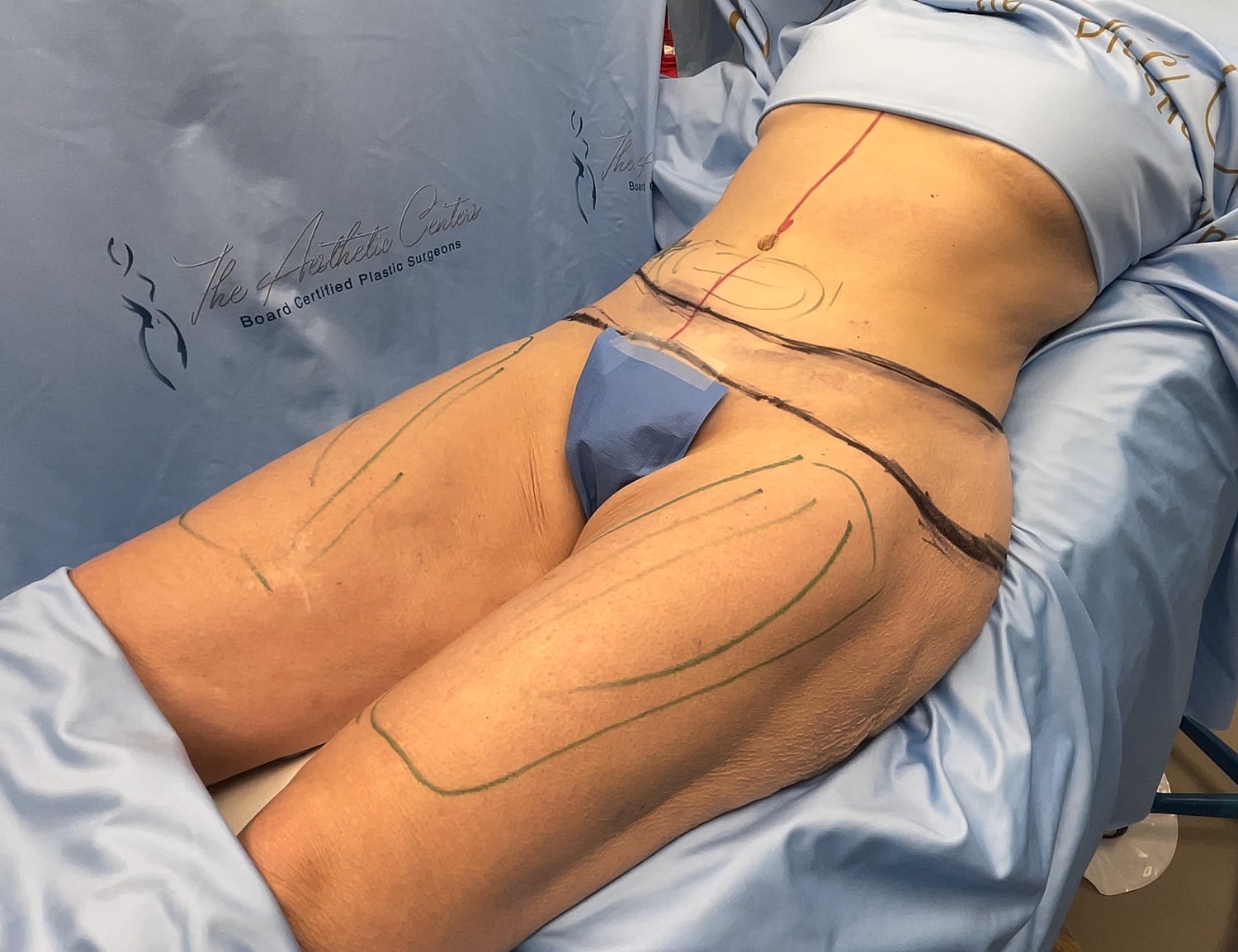 Patient prepared for cosmetic surgery procedure.
