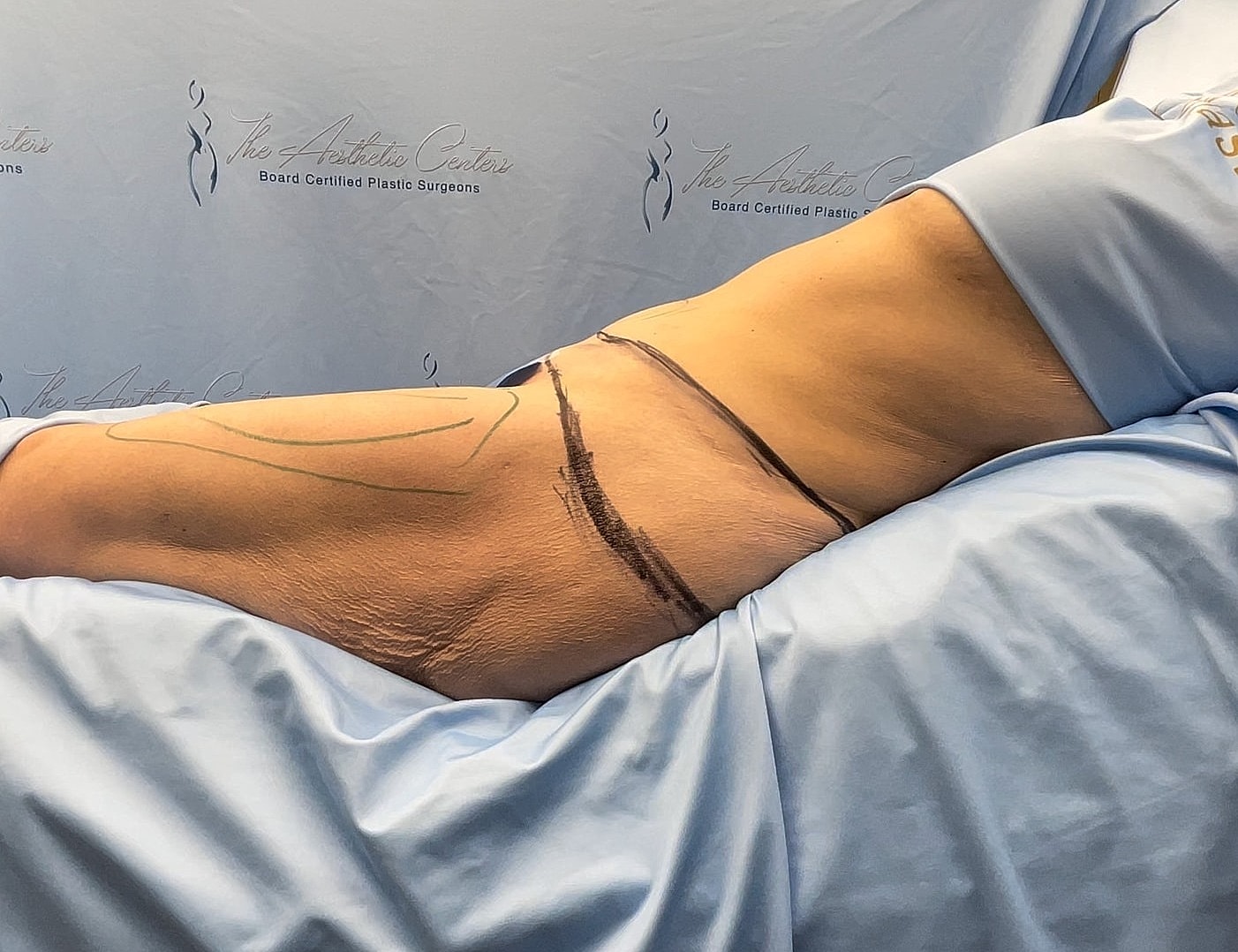 Surgical markings on patient's body for procedure.