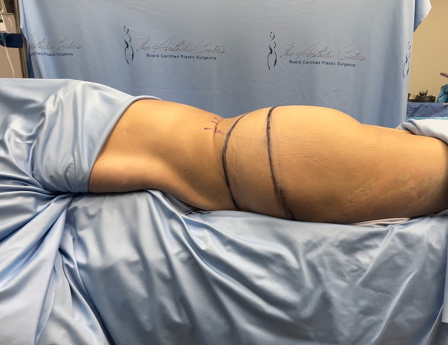 Patient preparation for cosmetic procedure in clinic