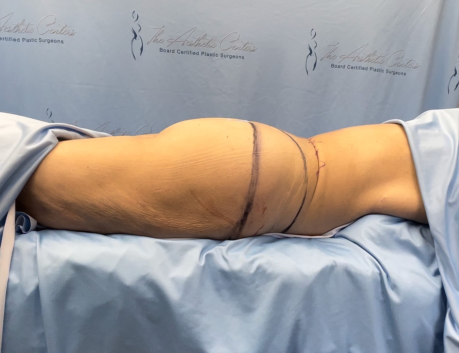 Surgical procedure on a patient’s side profile.