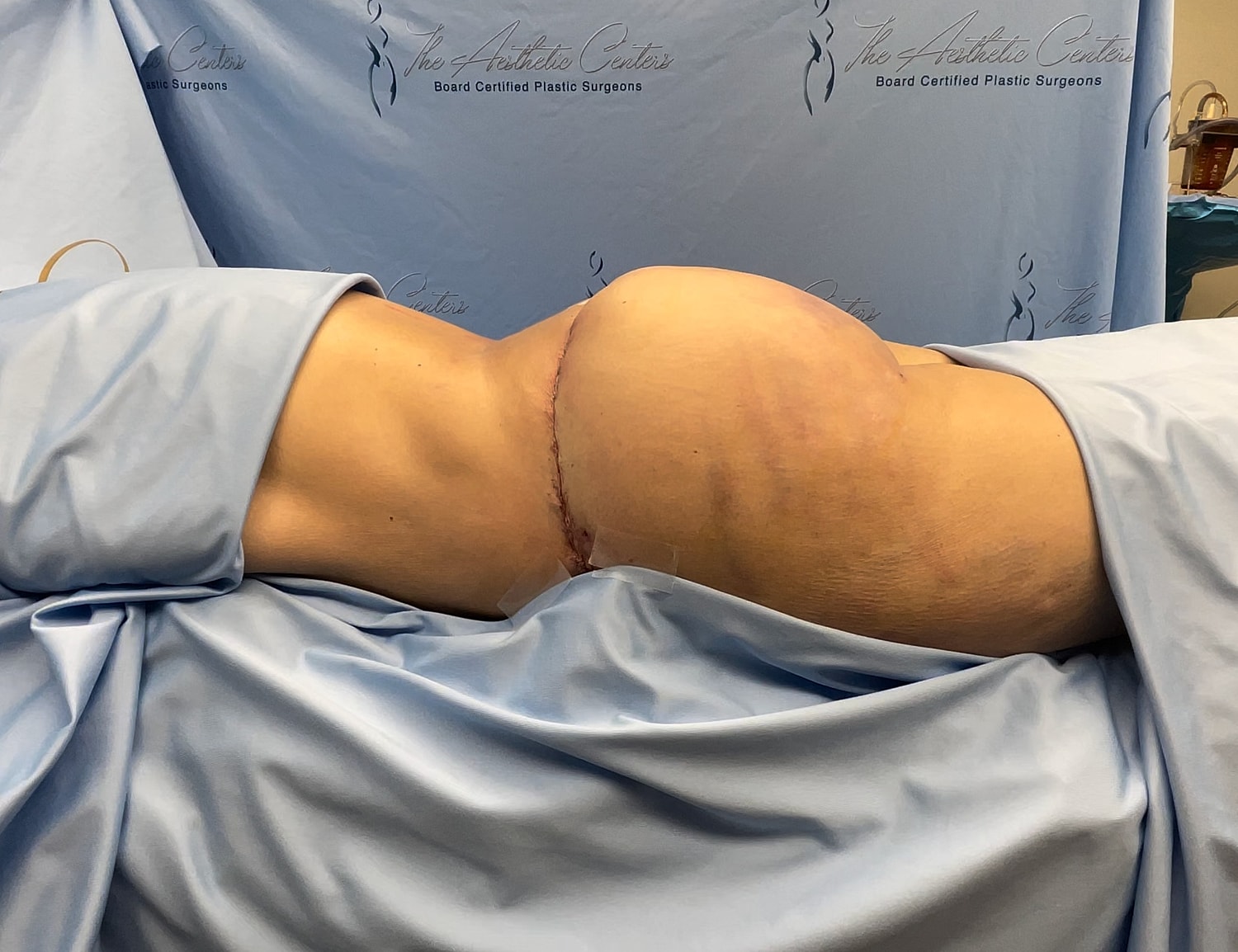 Patient lying on table post-surgery, visible scarring.