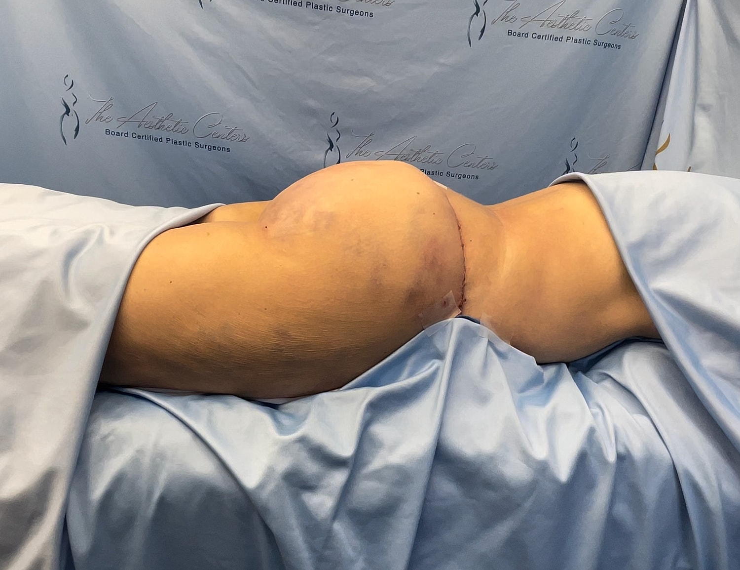 Post-surgery patient with bandaged body contour.