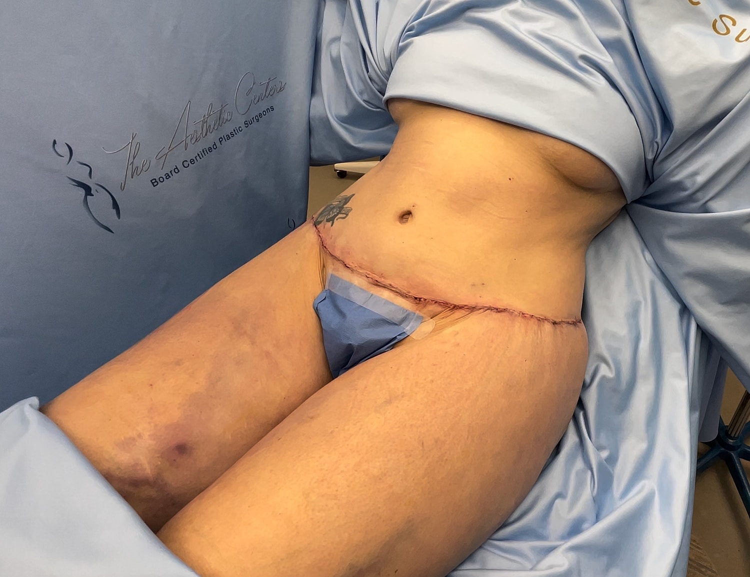 Post-surgery recovery with visible incision site.