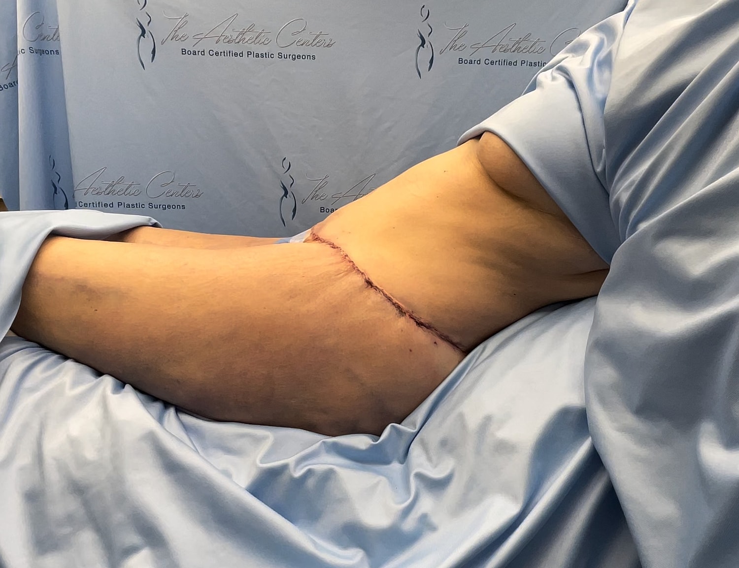 Surgical scar on arm after procedure.