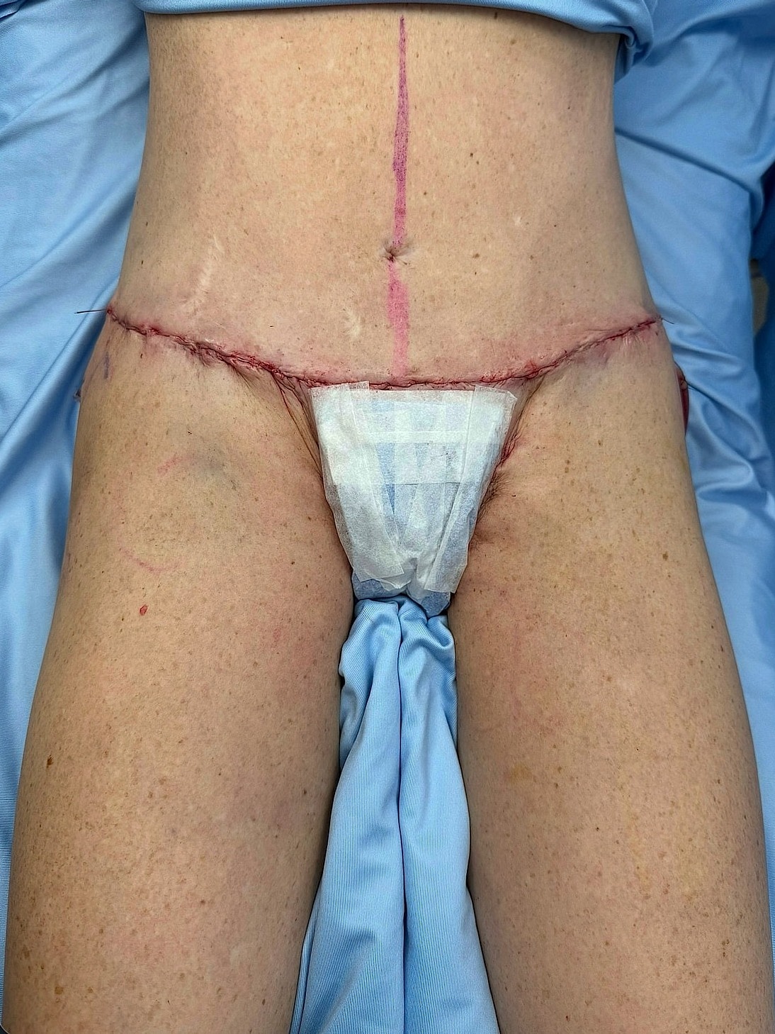 Surgical site on lower abdomen with dressings.